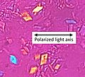 Birefringence microscopy of pseudogout, annotated
