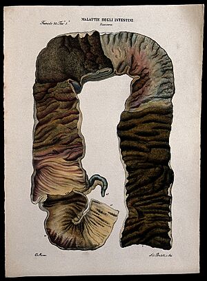 A cross-section of diseased intestines (dysentery). Coloured Wellcome V0009858ER