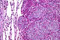 Ewing sarcoma - PAS - very high mag