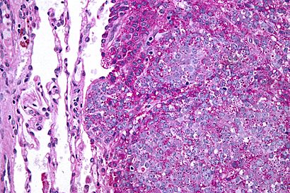 Ewing sarcoma - PAS - very high mag.jpg