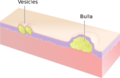 Vesicles and Bulla